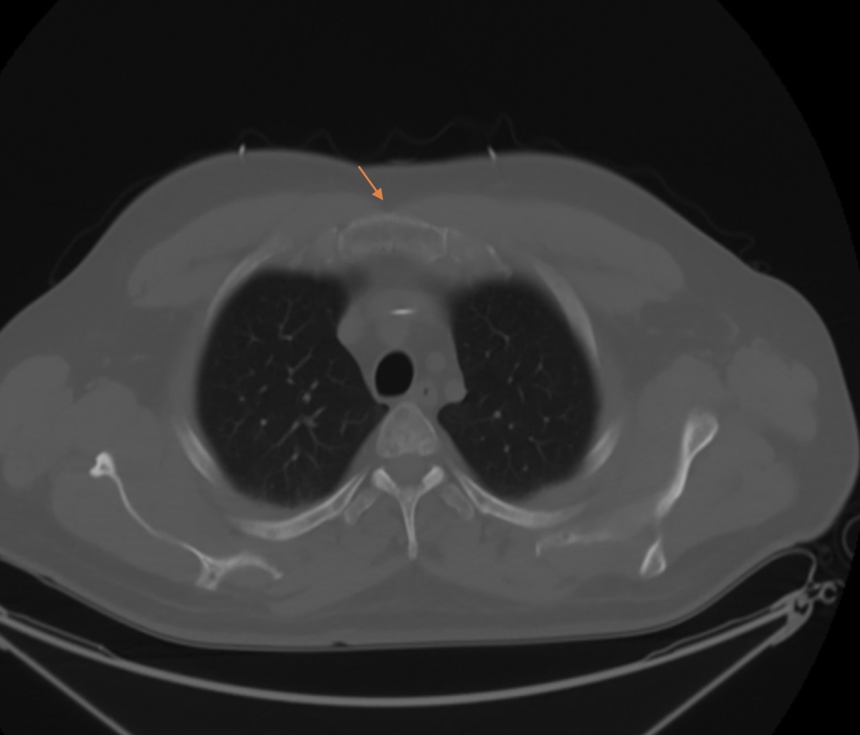 Figure 1 CT scan of chest showing lytic lesions arrow