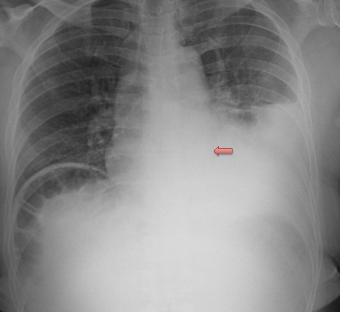 Figure 7 X-ray demonstrating large pleural effusion and paraspinal mass red arrow
