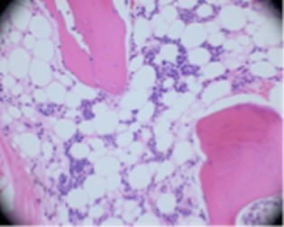 Figure 10 Bone marrow biopsy revealing hypocellular bone marrow with trilineage hypoplasia