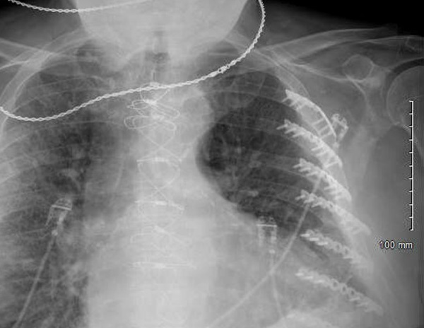 Figure 3 Chest X-ray showing cardiomegaly with mild pulmonary congestion and possible consolidation in the right midlung