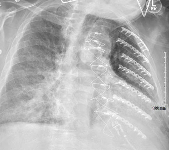 Figure 4 Repeat chest X-ray showing new right lung airspace opacities