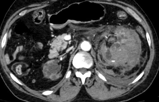 Figure 6 CT of the abdomen revealing retroperitoneal hemorrhage