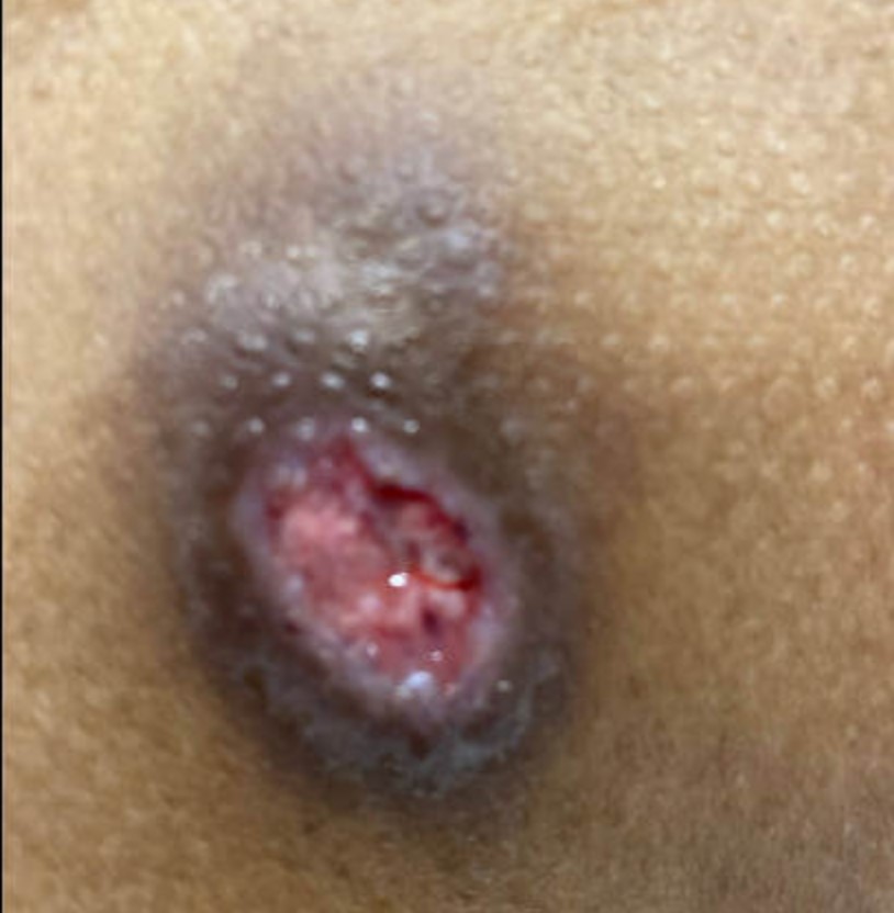Figure 7 Verrucous lesion on lower back May 2022