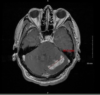 Figure 9 MRI showing heterogeneous enhancing left cerebellar mass with adjacent edema and effacement of the fourth ventricle